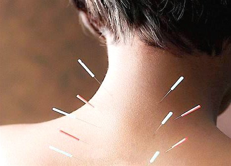 Experto/a MTC en acupuntura